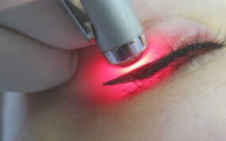 Все о лазерном удалении татуажа бровей