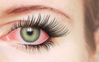 Что делать, если после наращивания ресниц покраснели глаза??