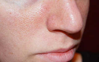 Как избавиться от темных кругов под глазами