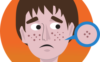 Прыщи: можно ли выдавливать, правильная техника выдавливания прыщей