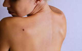 Салонные процедуры по удалению родинок на бровях: преимущества и недостатки