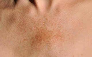Пигментные пятна на лице: причины, как убрать, отзывы, удаление, лучшие средства