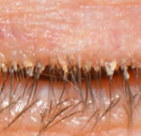 Лечение ресниц при демодекозе, аллергии и других заболеваниях