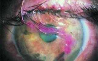 Химический ожог слизистой глаза после наращивания ресниц