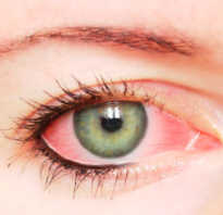 Что делать, если болят глаза после наращивания ресниц??