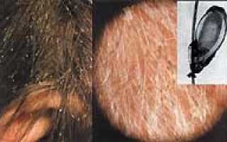 Чем можно вывести вшей при беременности: надежные средства