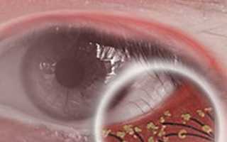 Клещ демодекс на ресницах: лечение и симптомы