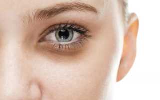 Как избавиться от синяков под глазами за один день в домашних условиях