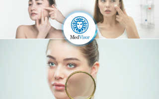 Салициловая кислота для лица: применение, польза, вред, как использовать, лучшие крема, маски и пиллинги с салициловой кислотой