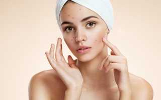 Пятна на лице: причины, что делать, как убрать, удалить и вывести